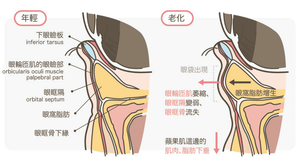 客製化_眼袋_手術_內開_外開_隱痕_改善_淚溝_臥蠶_眼尾下垂_細紋_黑眼圈_全臉補脂_蘋果肌_法令紋_夫妻宮_填充_恢復期_傷口_麻醉
