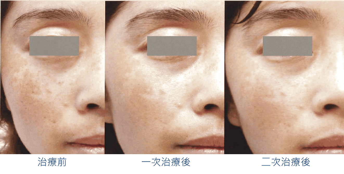 M22_彩衝光雷射_lumenis_雀斑_葡萄酒色斑_肝斑_咖啡牛奶斑_老人斑_改善_刺青_斑點_毛孔_痘疤_細紋_色素不均_黑色素_除斑_案例照