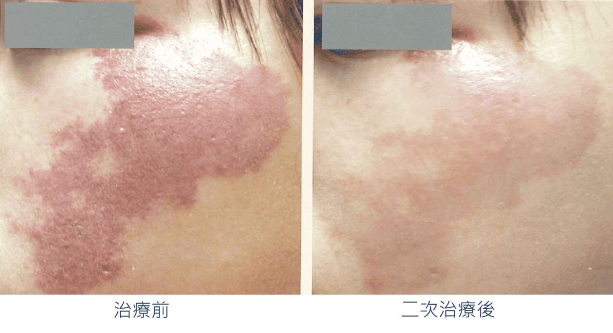 M22_彩衝光雷射_lumenis_雀斑_葡萄酒色斑_肝斑_咖啡牛奶斑_老人斑_改善_刺青_斑點_毛孔_痘疤_細紋_色素不均_黑色素_除斑_案例照