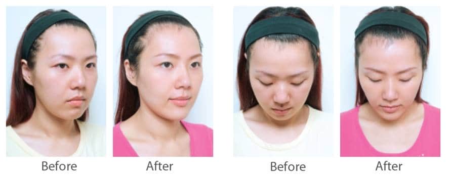juvederm_喬雅登_玻尿酸_美國_額頭_夫妻宮_蘋果肌_淚溝_木偶紋_法令紋_鼻子_山根_下巴_脖紋_豐唇_豐頰_頰凹_改善_注射_填充_案例照
