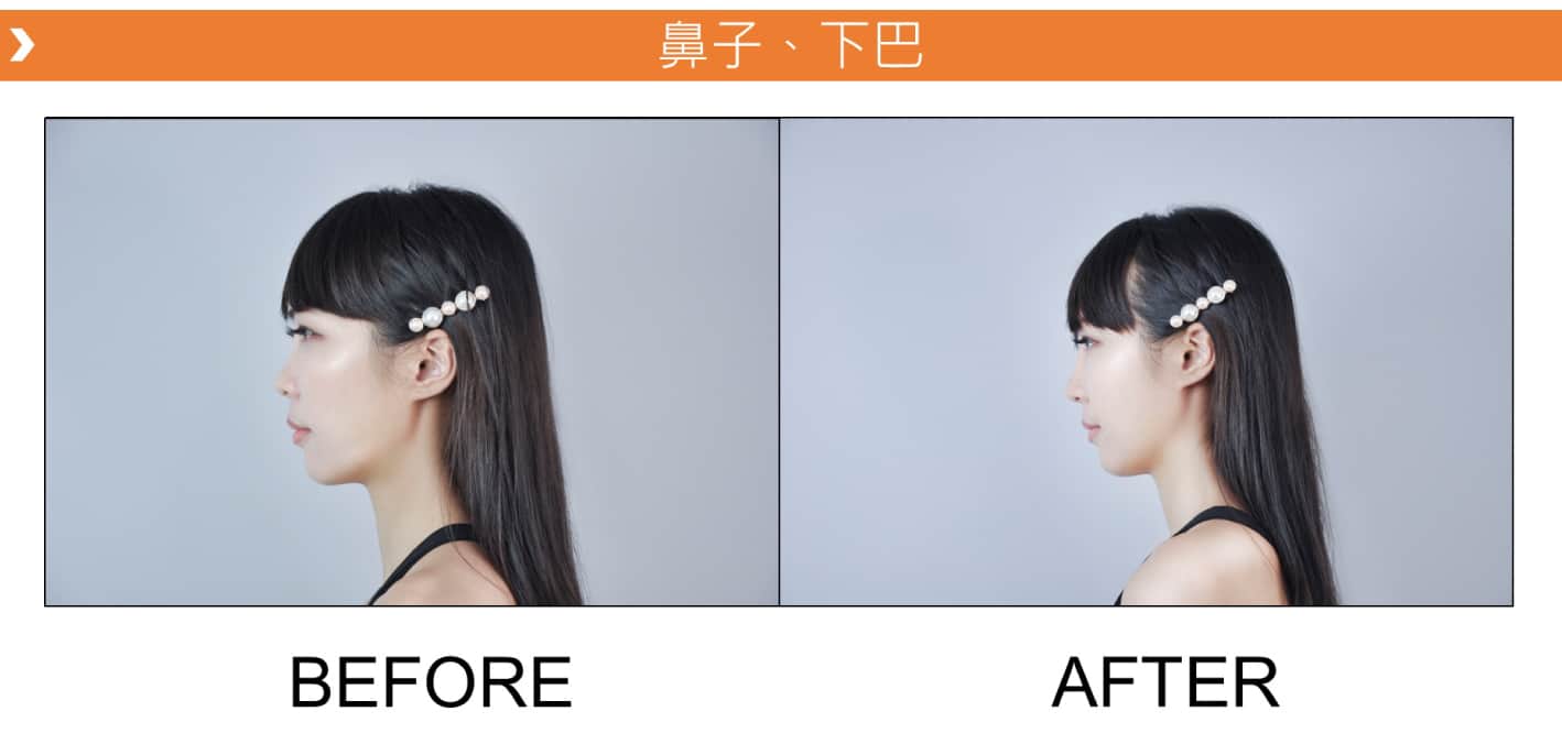 V18_愛馬仕_玻尿酸_德國_維持_18個月_額頭_夫妻宮_蘋果肌_淚溝_木偶紋_法令紋_鼻子_山根_下巴_脖紋_豐唇_豐頰_頰凹_改善_注射_填充_案例照