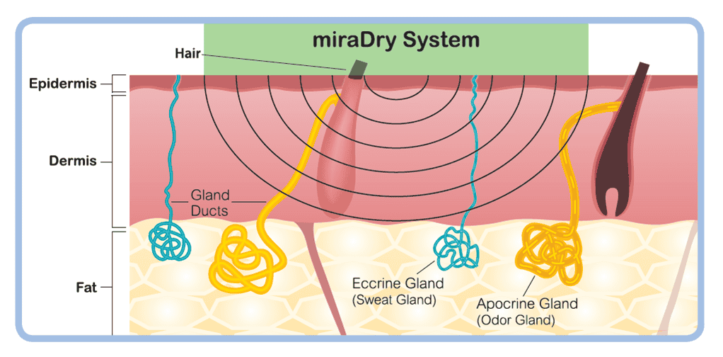 清新微波_miradry_腋下止汗_狐臭_改善_除汗_金額_價格_費用_副作用_元晨診所_忠孝復興_中山_板橋_台北_台中