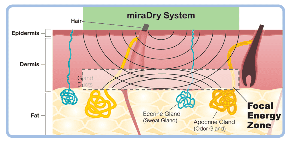 清新微波_miradry_腋下止汗_狐臭_改善_除汗_金額_價格_費用_副作用_元晨診所_忠孝復興_中山_板橋_台北_台中