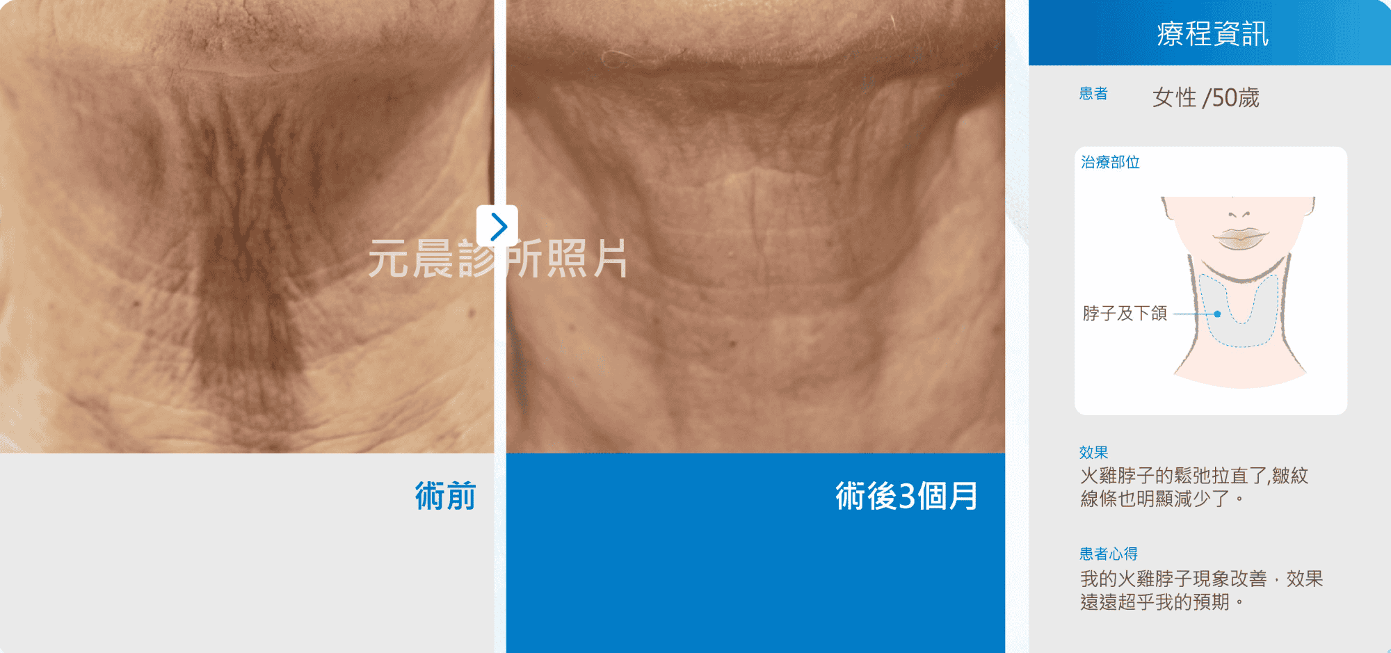 ultraformer_海芙音波_第三代音波_全臉緊實_法令紋_眼周緊實_紋路緊實_輪廓線緊實_身體緊實_魚尾紋_抬頭紋_木偶紋_蘋果肌