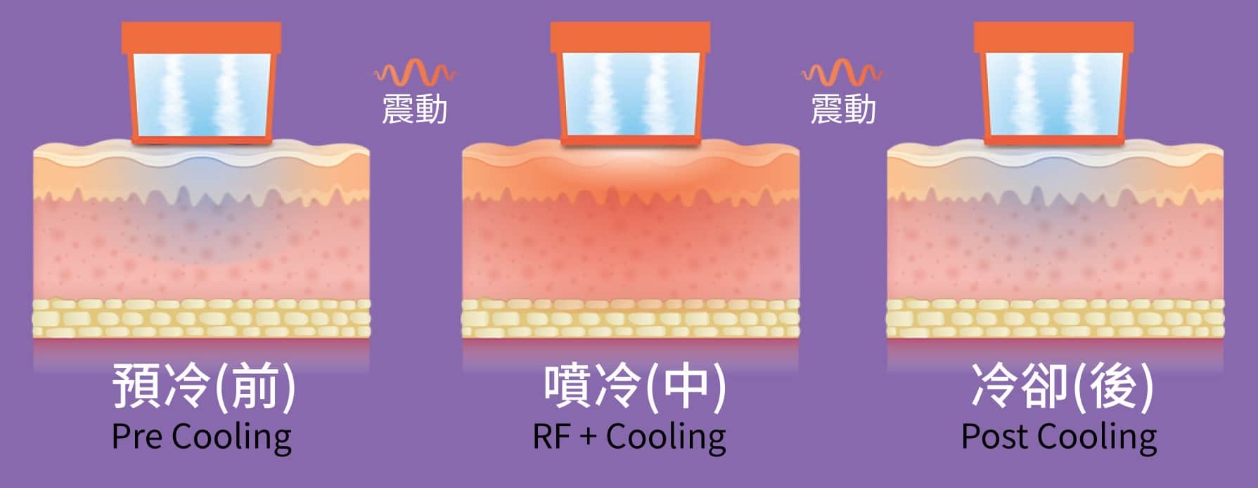 Oligio_玩美電波_Oligio玩美電波冷噴及震動原理
